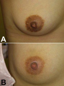 Before and after nipple bleaching